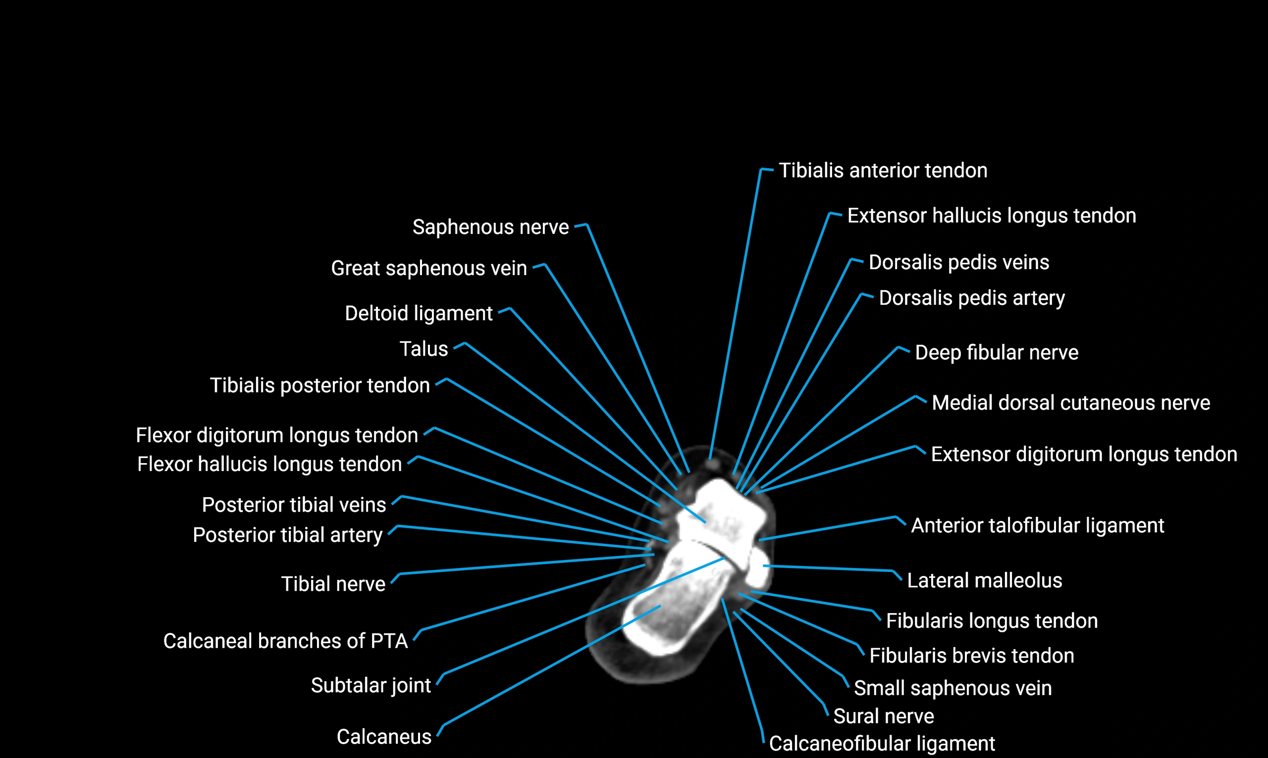CT lower limb axial cross sectional anatomy labelled image 169 (2).webp